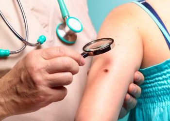 Top 4 Risk Factors of Melanoma and How You Can Prevent It