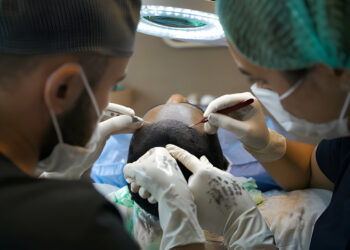 Hair Transplant in London